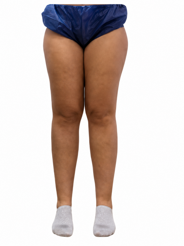tratamento para lipedema estagio 01