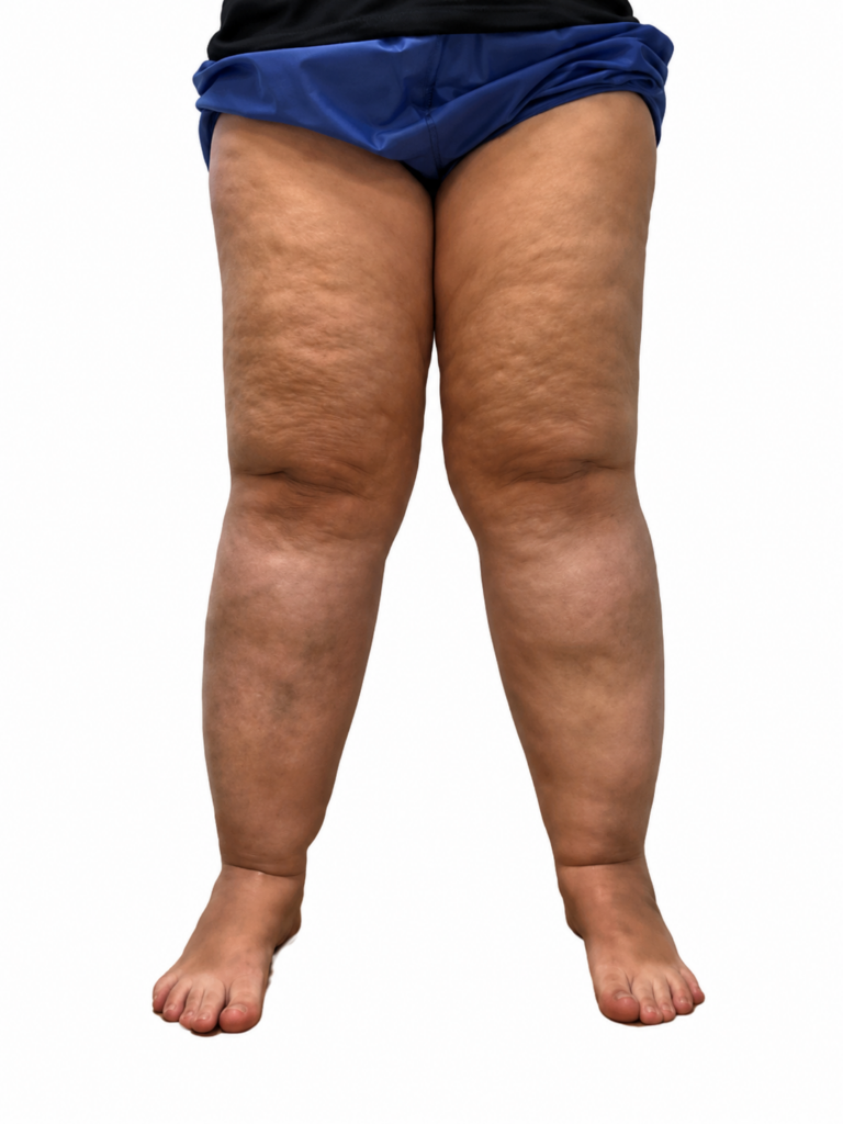 tratamento para lipedema estagio 03