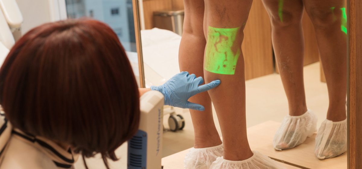 Tratamento Endolaser para varizes